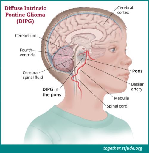 Diagram showing DIPG in the pons of the brainstem